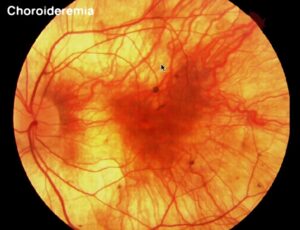 retinal photo of a patient with choroideremia